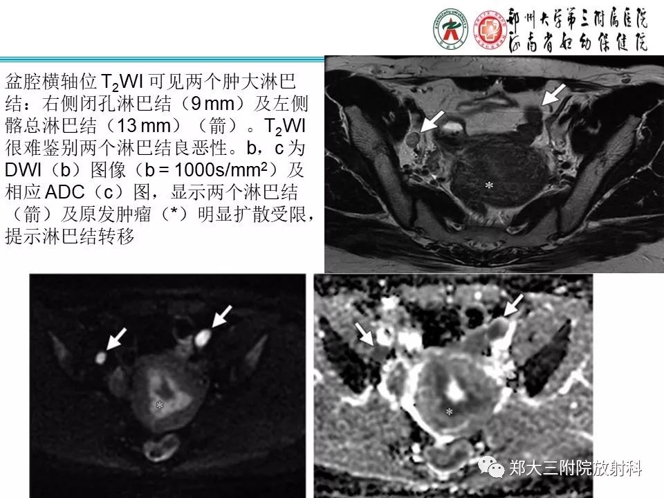 【PPT】如何判断盆腔肿瘤恶性淋巴结的转移