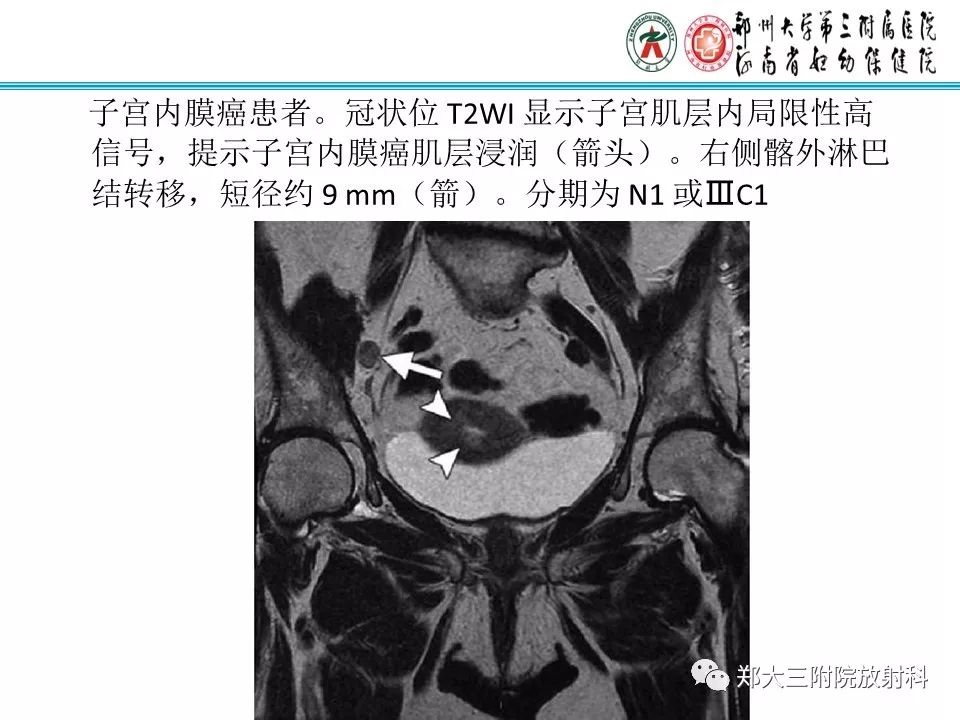 【PPT】如何判断盆腔肿瘤恶性淋巴结的转移