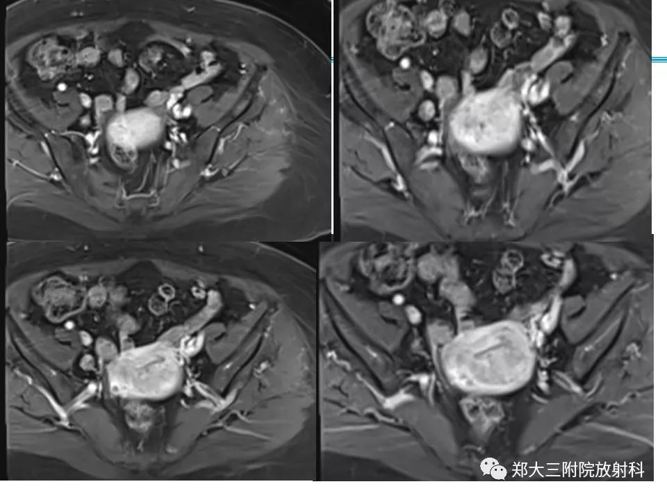 【PPT】如何判断盆腔肿瘤恶性淋巴结的转移