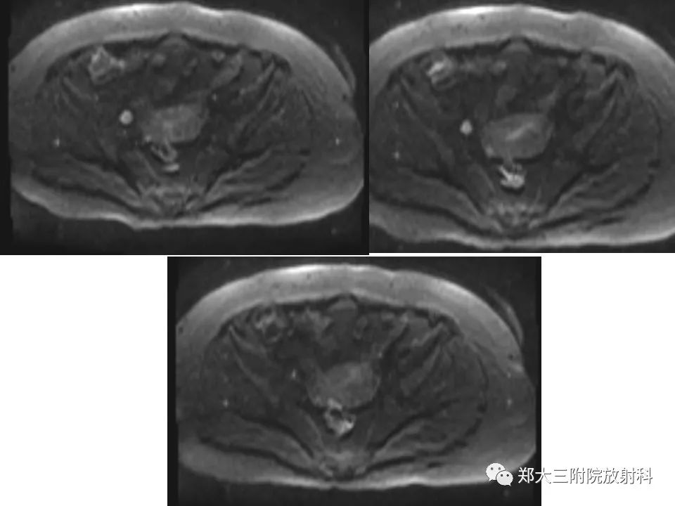【PPT】如何判断盆腔肿瘤恶性淋巴结的转移