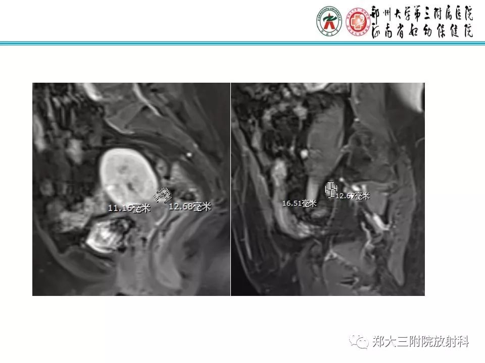 【PPT】如何判断盆腔肿瘤恶性淋巴结的转移