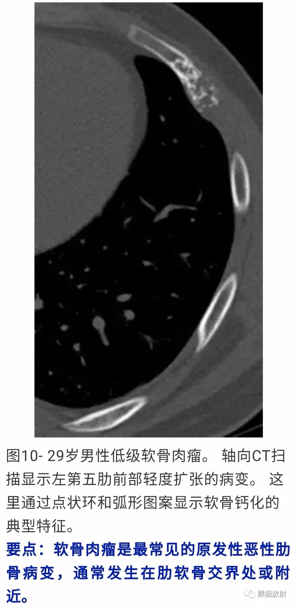 【病例】胸壁软骨肉瘤1例CT影像 【病例】胸壁软骨肉瘤1例CT影像