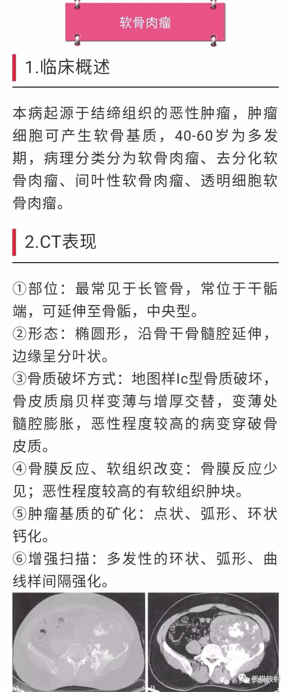 【病例】胸壁软骨肉瘤1例CT影像 【病例】胸壁软骨肉瘤1例CT影像
