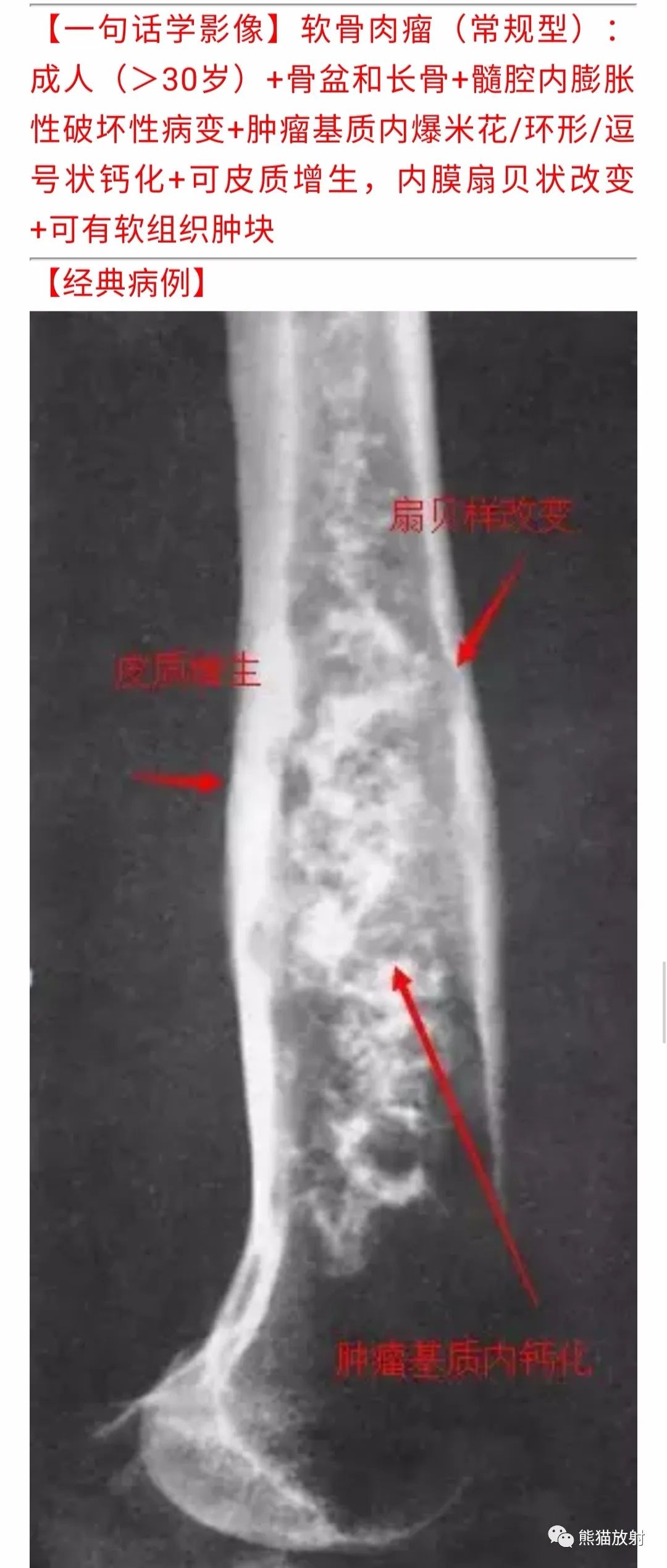 【病例】胸壁软骨肉瘤1例CT影像 【病例】胸壁软骨肉瘤1例CT影像
