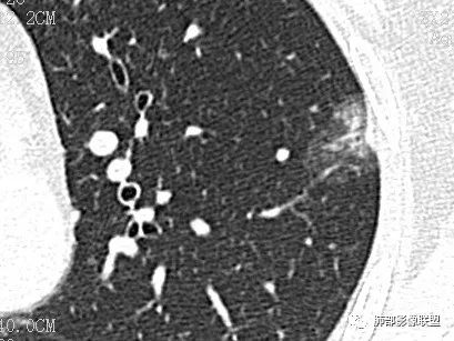 【病例】一眼识破的肺部新生物4例CT影像