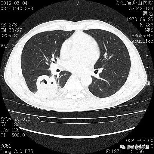 【病例】一眼识破的肺部新生物4例CT影像