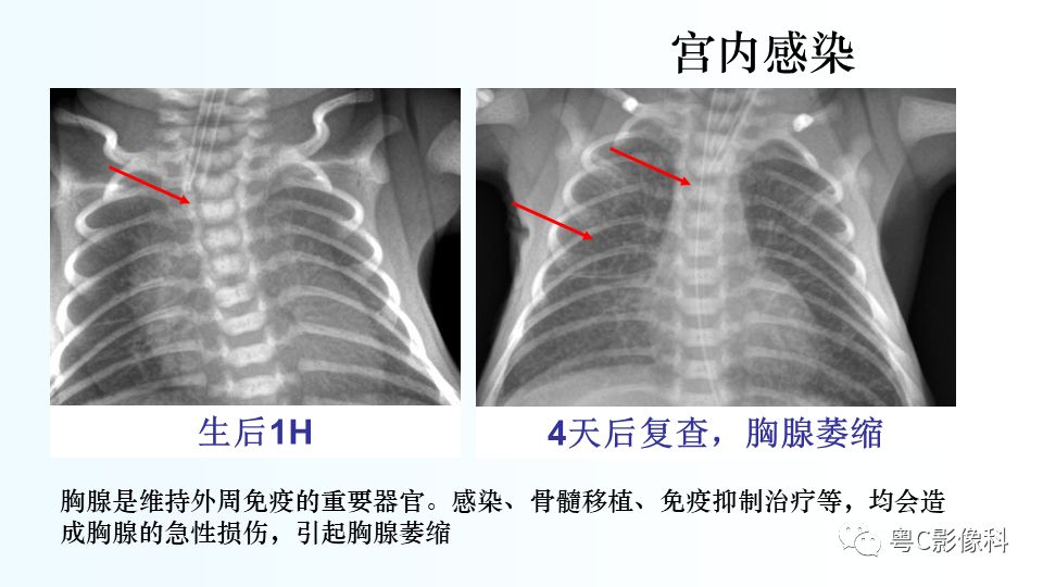 【PPT】儿童胸部影像诊断*基础病变