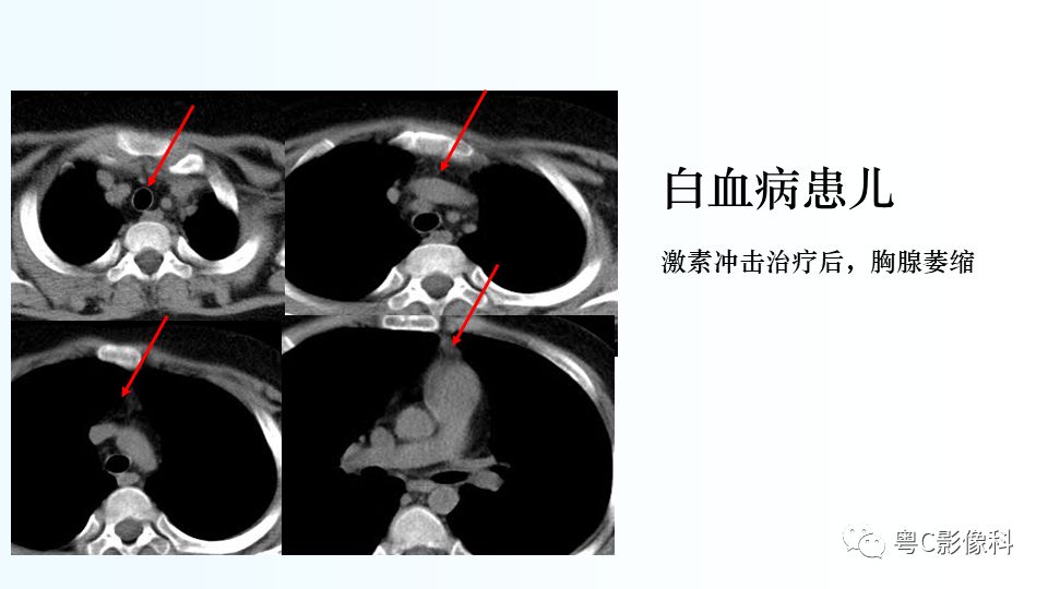 【PPT】儿童胸部影像诊断*基础病变