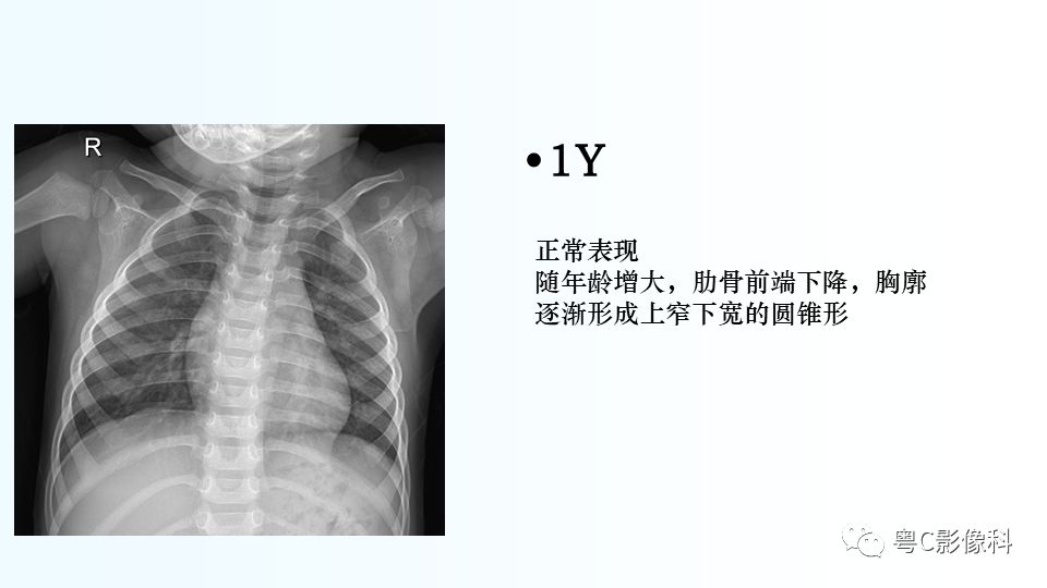 【PPT】儿童胸部影像诊断*基础病变