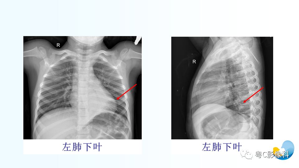 【PPT】儿童胸部影像诊断*基础病变