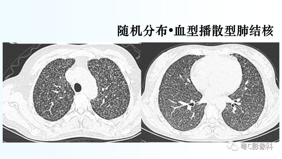【PPT】儿童胸部影像诊断*基础病变