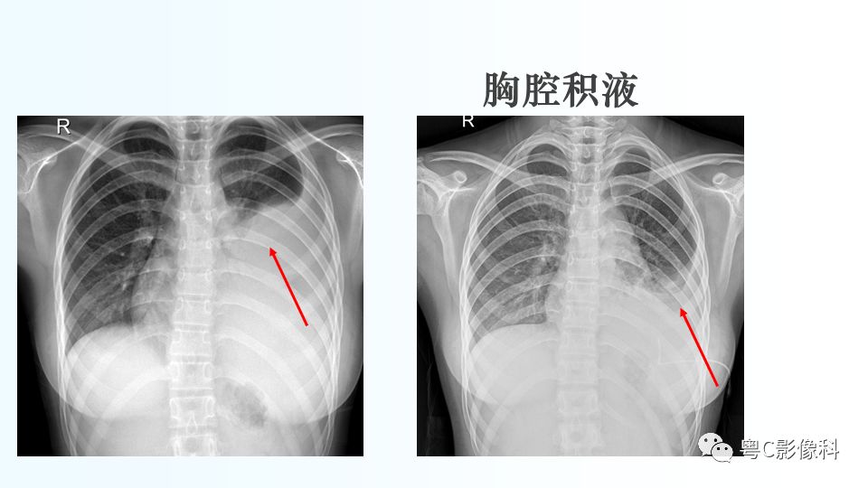 【PPT】儿童胸部影像诊断*基础病变