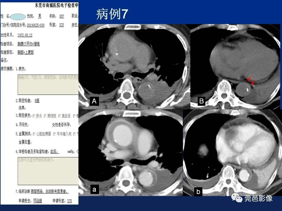 【PPT】急性主动脉综合征