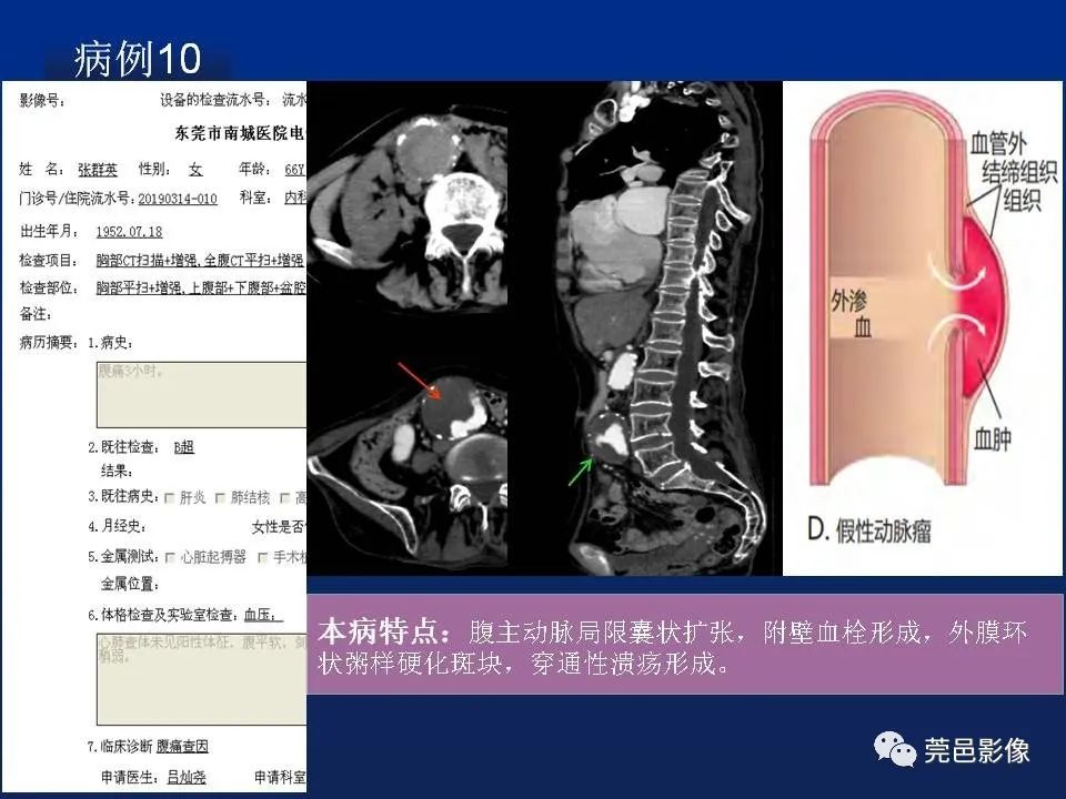 【PPT】急性主动脉综合征