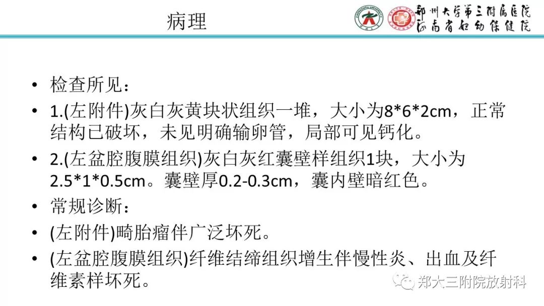 【病例】卵巢未成熟畸胎瘤1例MR影像