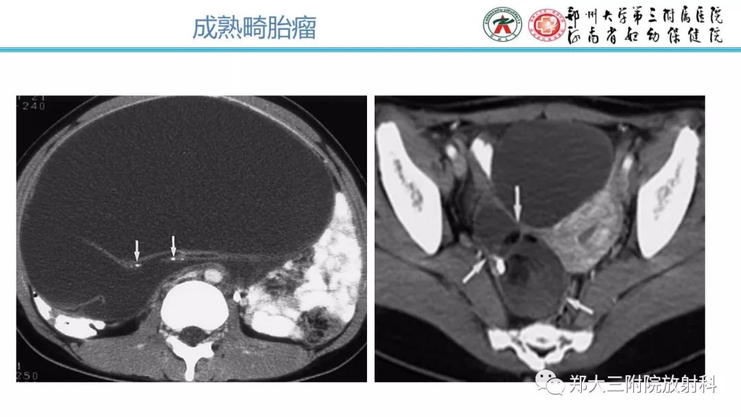 【病例】卵巢未成熟畸胎瘤1例MR影像