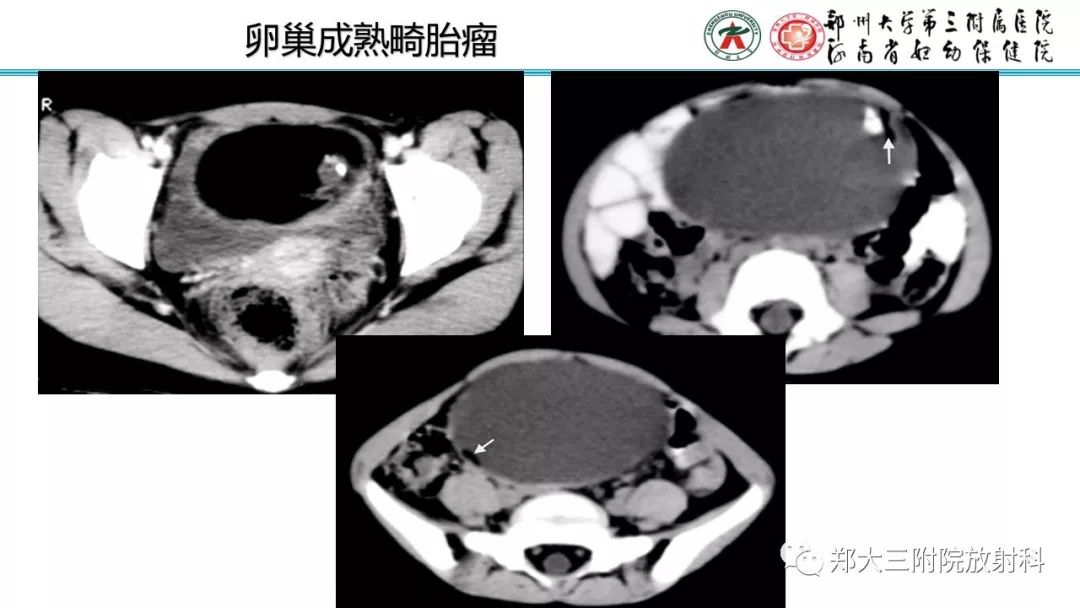 【病例】卵巢未成熟畸胎瘤1例MR影像