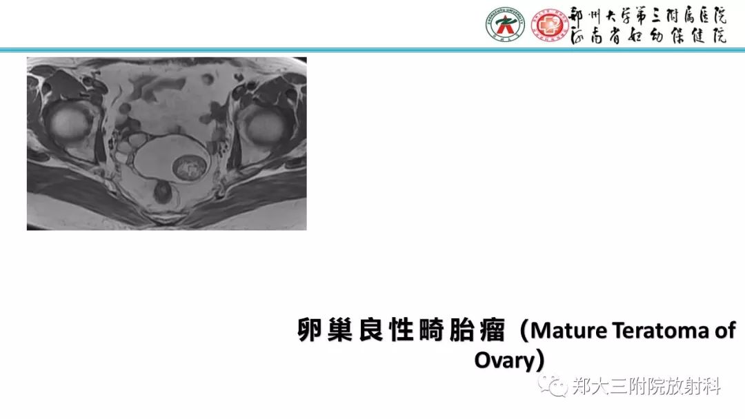 【病例】卵巢未成熟畸胎瘤1例MR影像