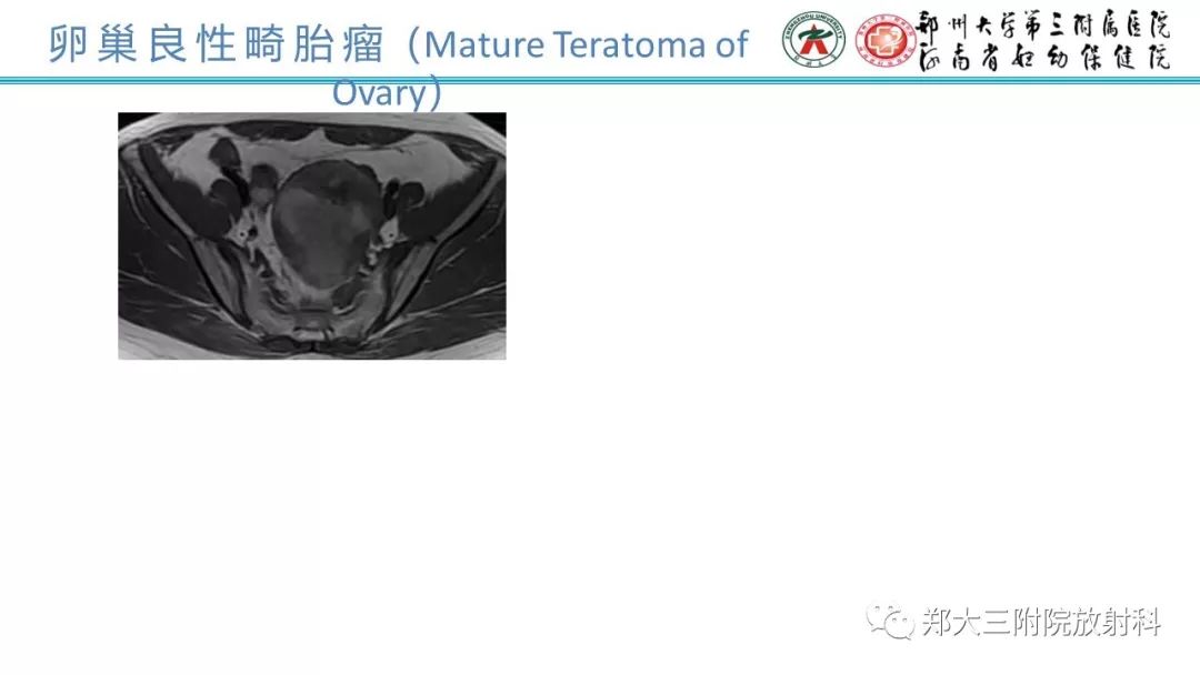 【病例】卵巢未成熟畸胎瘤1例MR影像