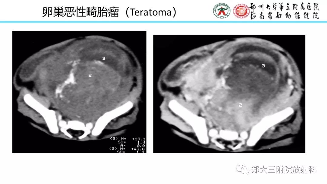 【病例】卵巢未成熟畸胎瘤1例MR影像