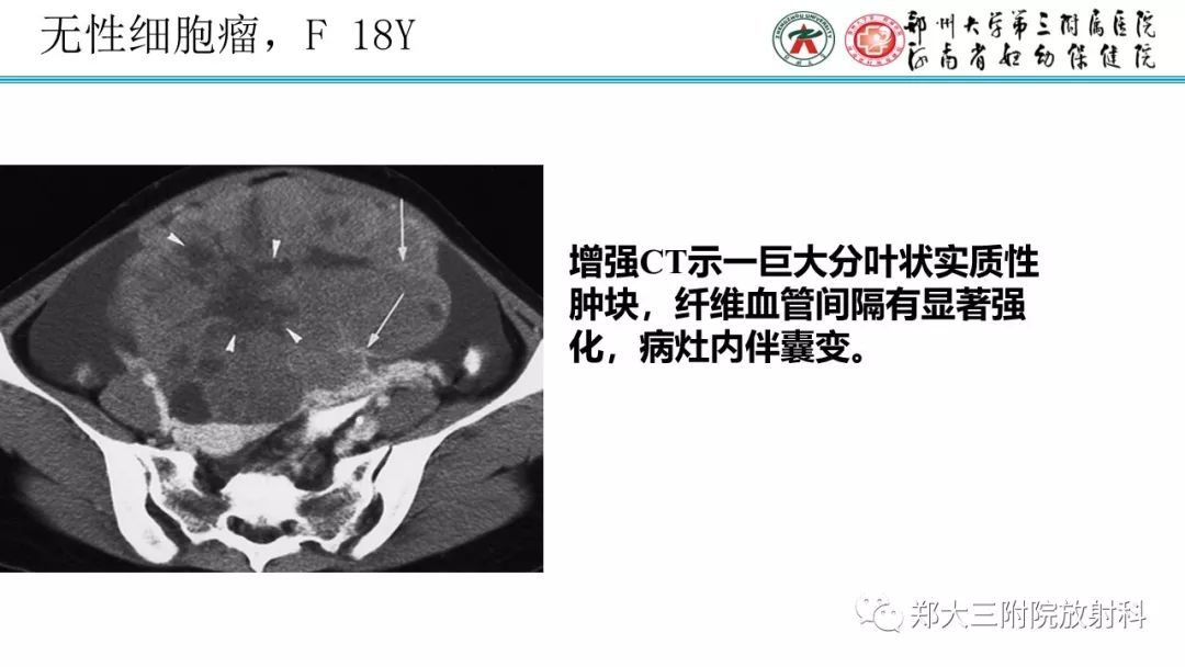 【病例】卵巢未成熟畸胎瘤1例MR影像