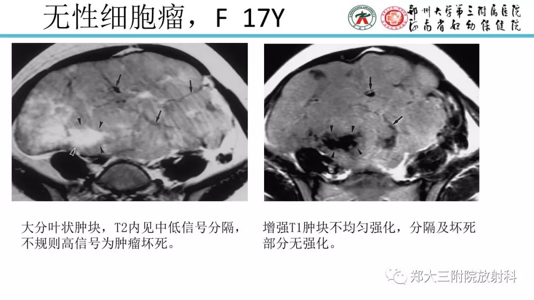 【病例】卵巢未成熟畸胎瘤1例MR影像