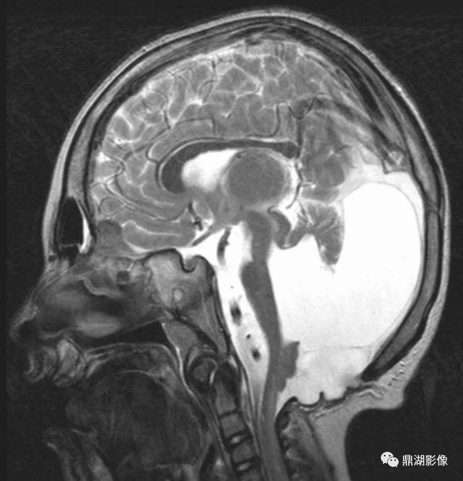 先天性第四脑室中、侧孔闭锁综合征 先天性第四脑室中、侧孔闭锁综合征