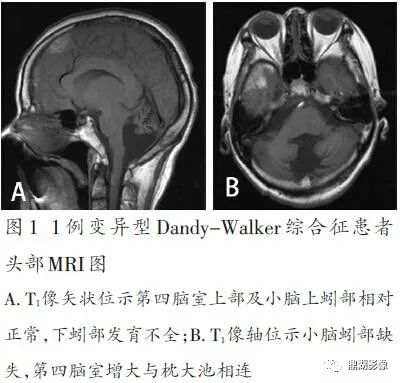 先天性第四脑室中、侧孔闭锁综合征 先天性第四脑室中、侧孔闭锁综合征