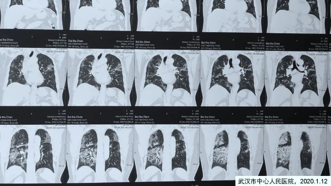 【病例】新冠肺炎2例CT影像