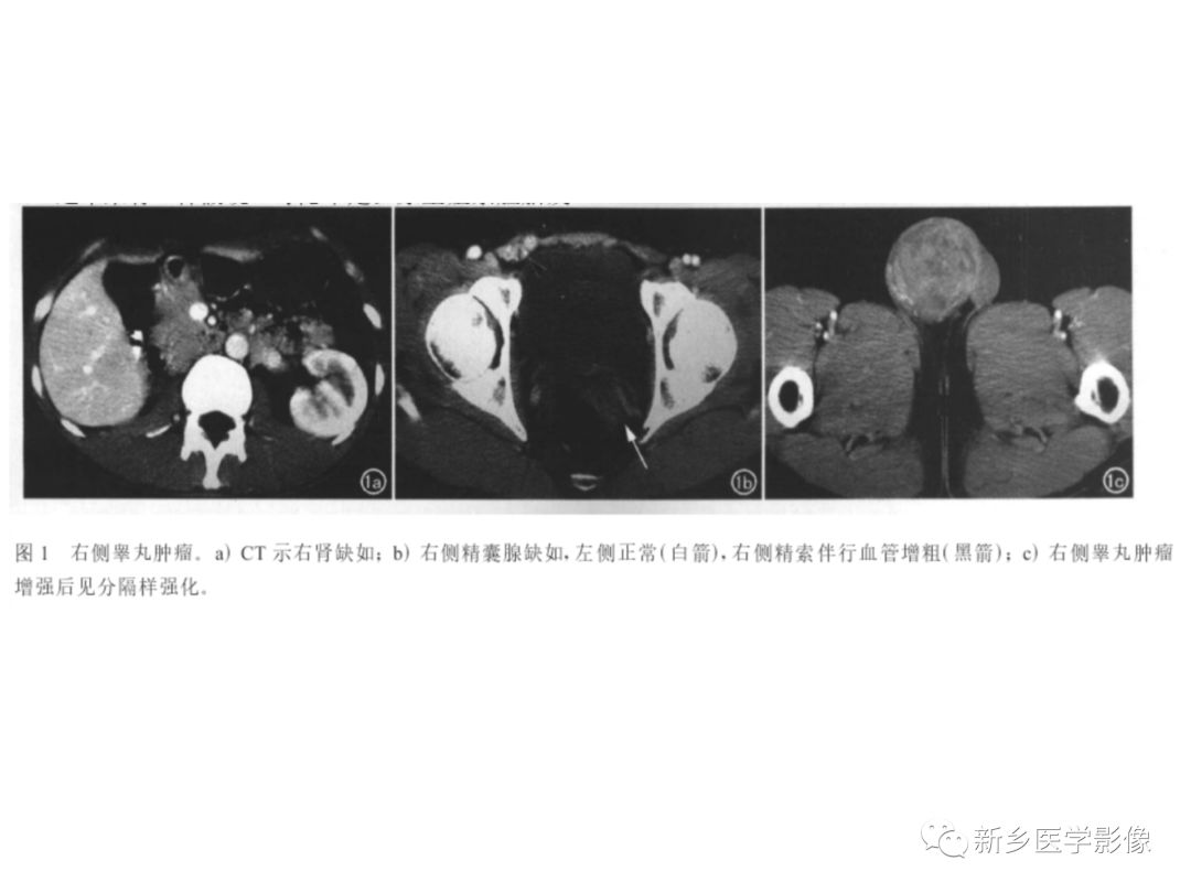 【PPT】睾丸精原细胞瘤