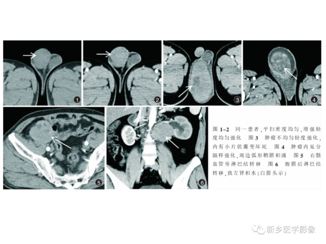 【PPT】睾丸精原细胞瘤