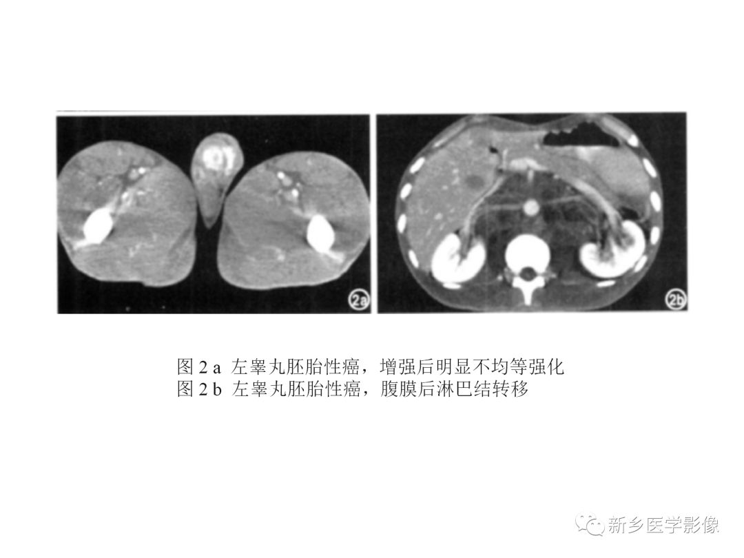 【PPT】睾丸精原细胞瘤