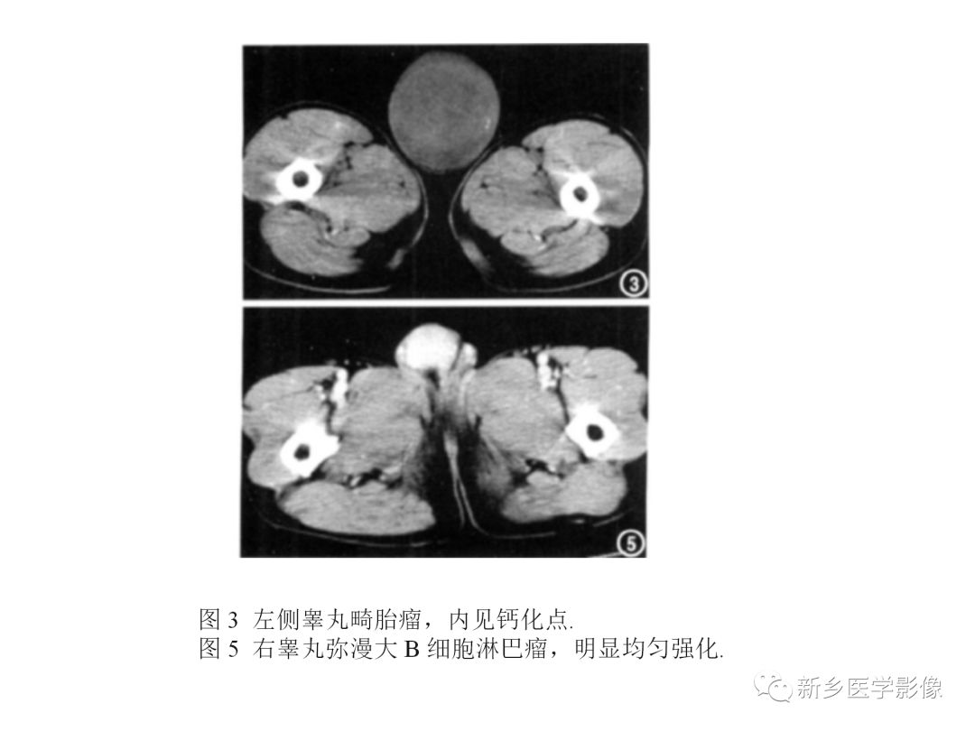 【PPT】睾丸精原细胞瘤