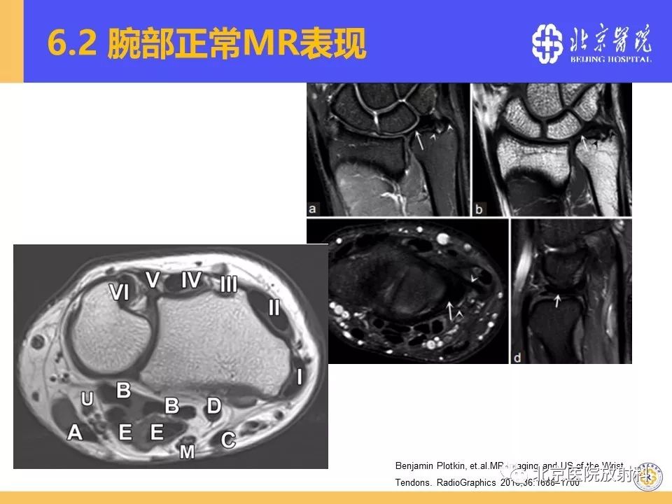【PPT】三角纤维软骨复合体（TFCC）损伤