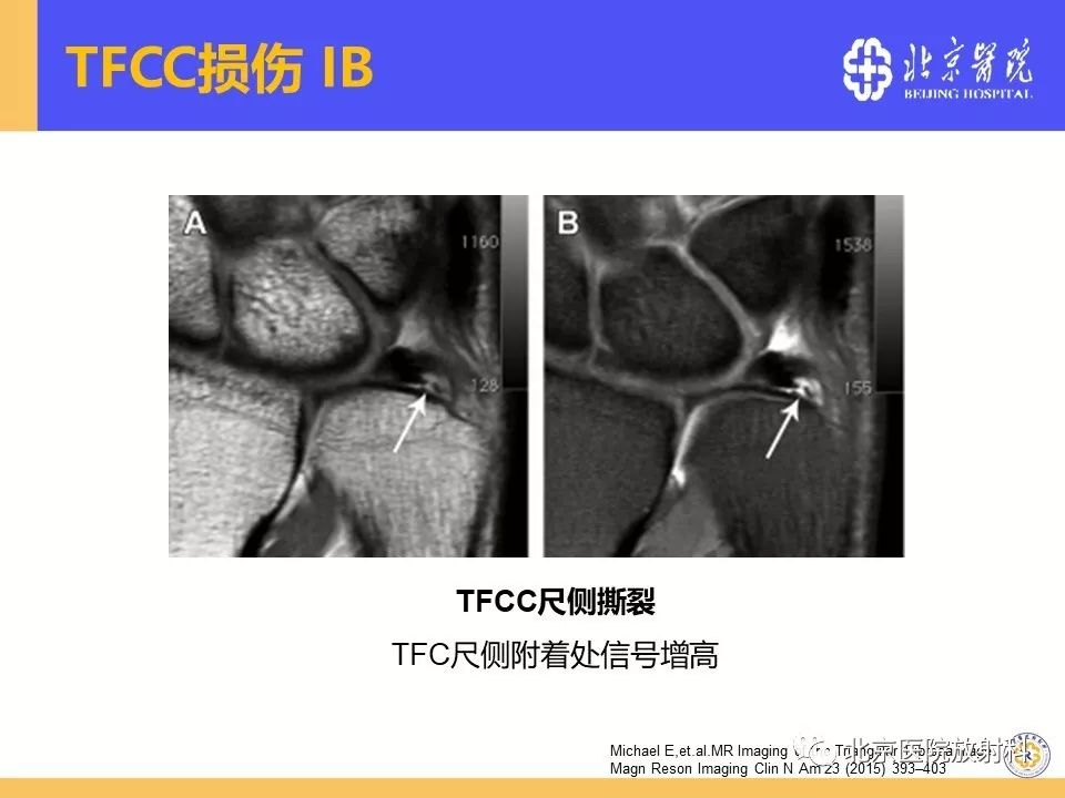【PPT】三角纤维软骨复合体（TFCC）损伤