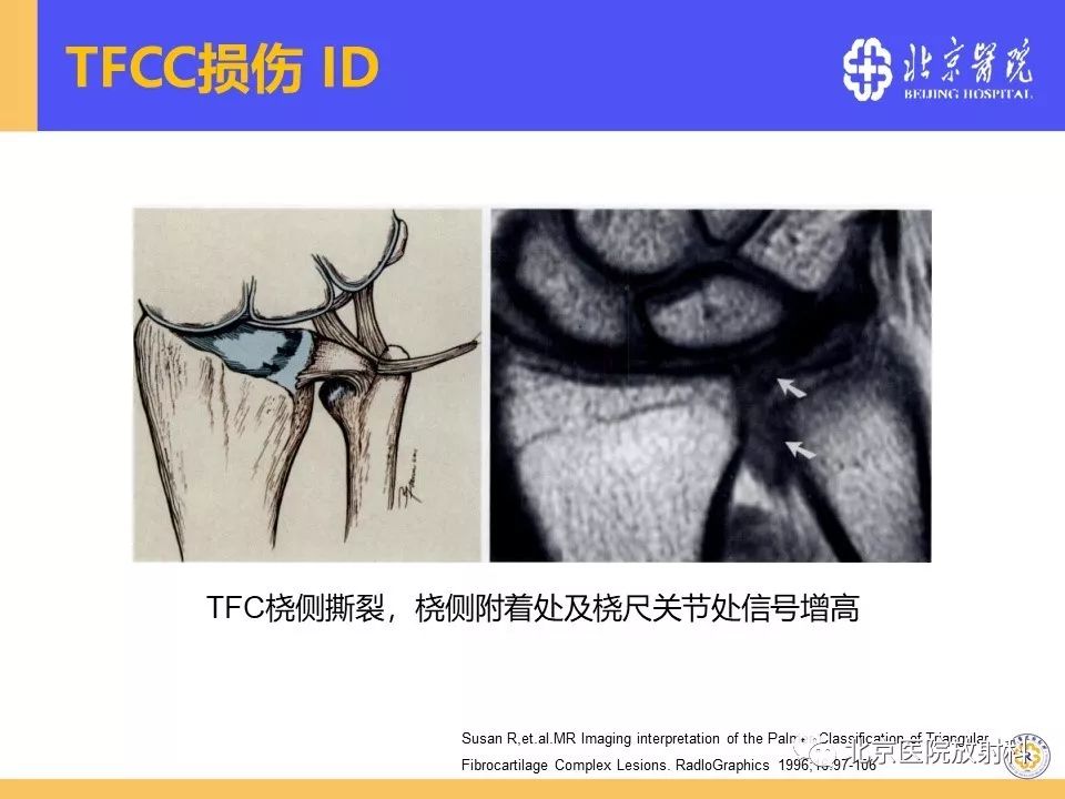 【PPT】三角纤维软骨复合体（TFCC）损伤