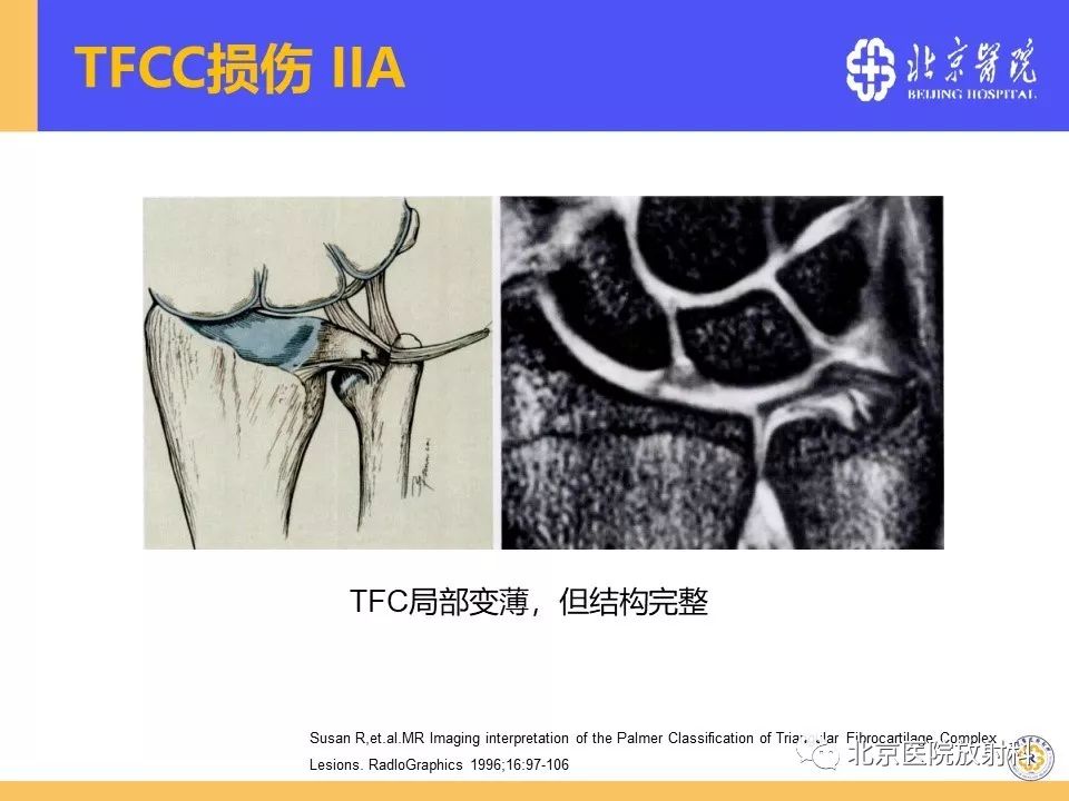 【PPT】三角纤维软骨复合体（TFCC）损伤