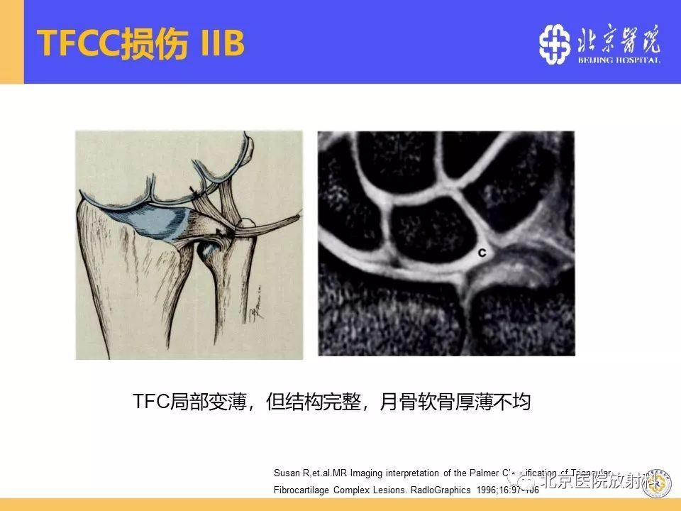【PPT】三角纤维软骨复合体（TFCC）损伤