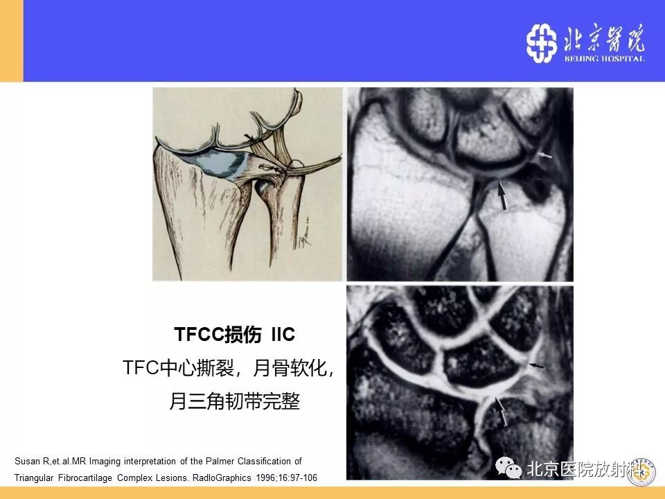 【PPT】三角纤维软骨复合体（TFCC）损伤