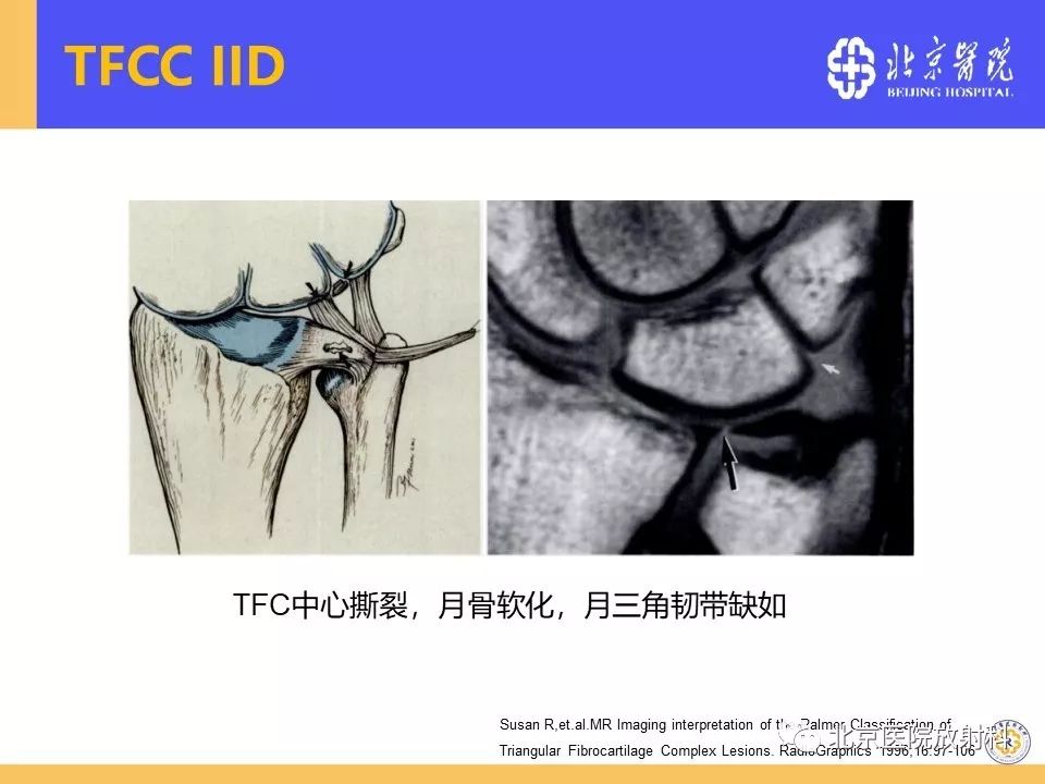 【PPT】三角纤维软骨复合体（TFCC）损伤