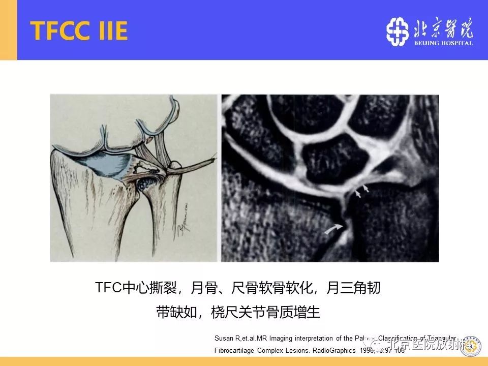 【PPT】三角纤维软骨复合体（TFCC）损伤