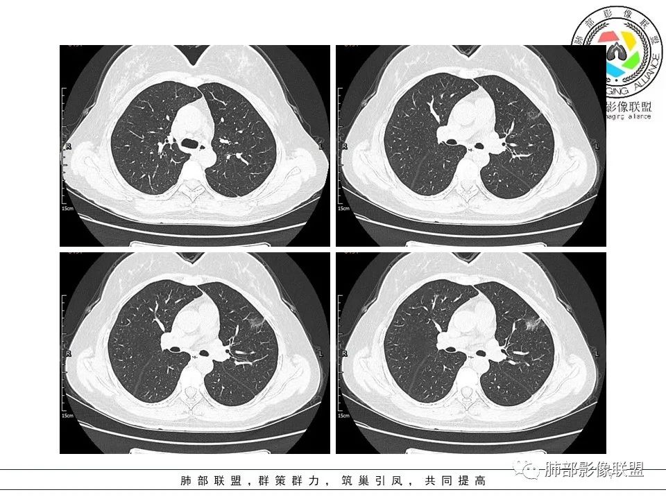 【病例】左肺上叶腺癌1例CT影像讨论 【病例】左肺上叶腺癌1例CT影像讨论