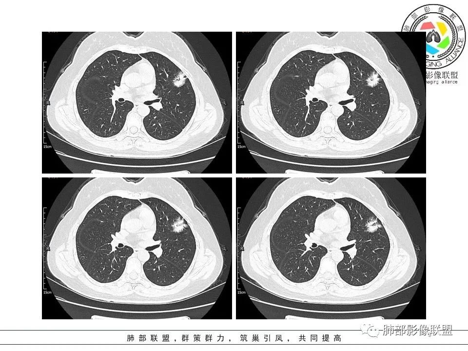 【病例】左肺上叶腺癌1例CT影像讨论 【病例】左肺上叶腺癌1例CT影像讨论