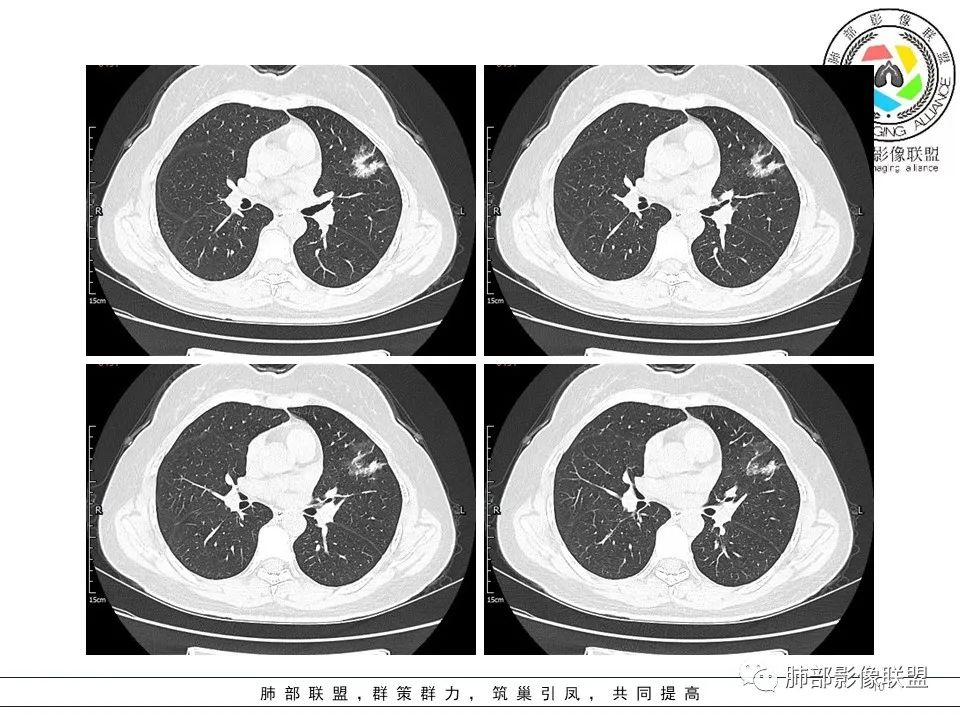 【病例】左肺上叶腺癌1例CT影像讨论 【病例】左肺上叶腺癌1例CT影像讨论