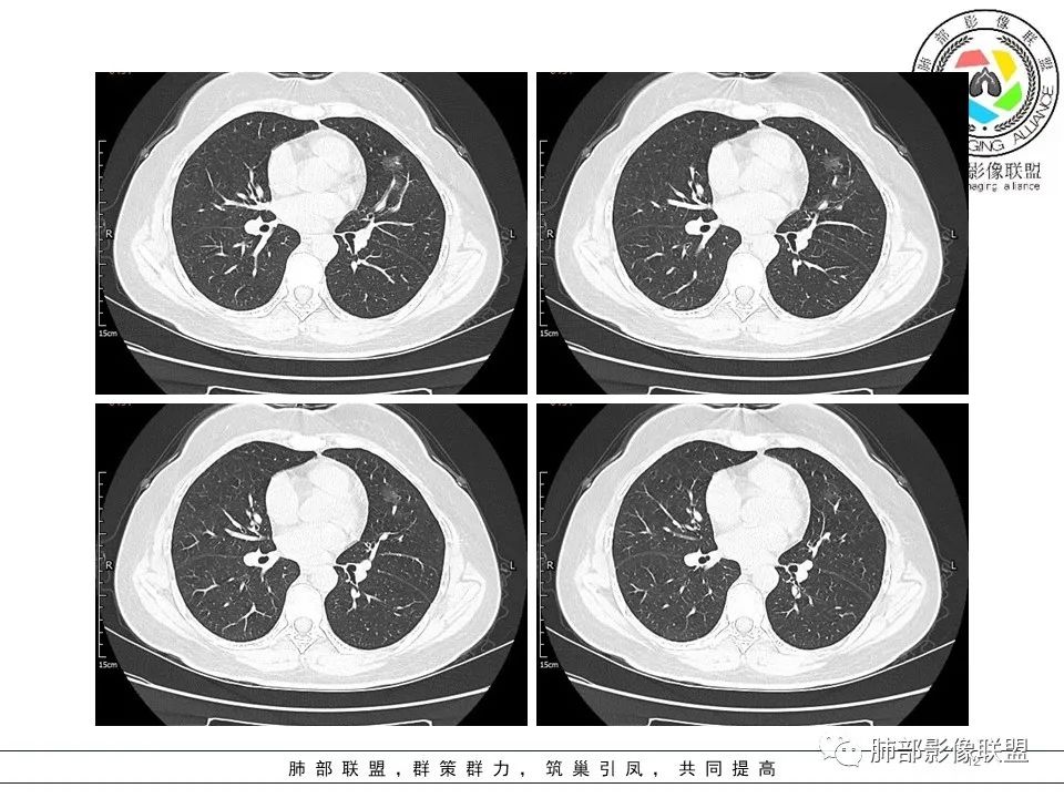 【病例】左肺上叶腺癌1例CT影像讨论 【病例】左肺上叶腺癌1例CT影像讨论