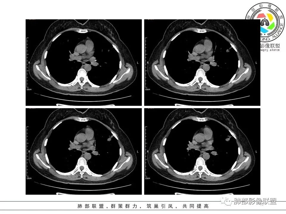 【病例】左肺上叶腺癌1例CT影像讨论 【病例】左肺上叶腺癌1例CT影像讨论