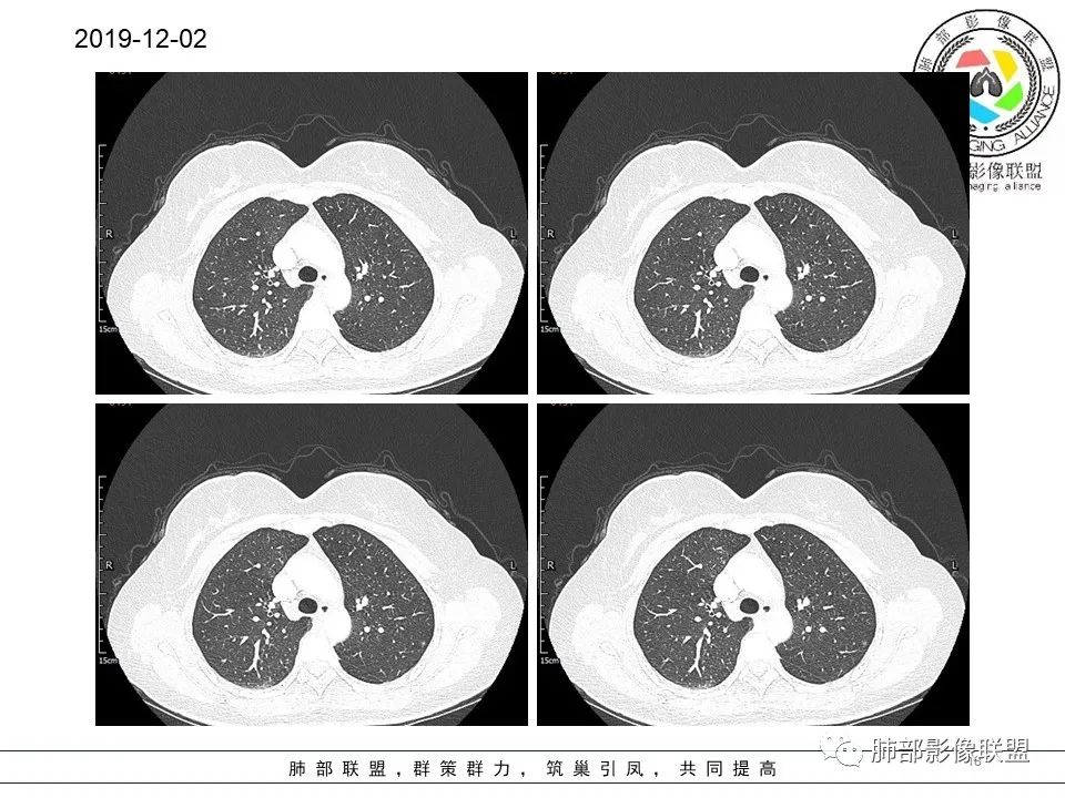 【病例】左肺上叶腺癌1例CT影像讨论 【病例】左肺上叶腺癌1例CT影像讨论