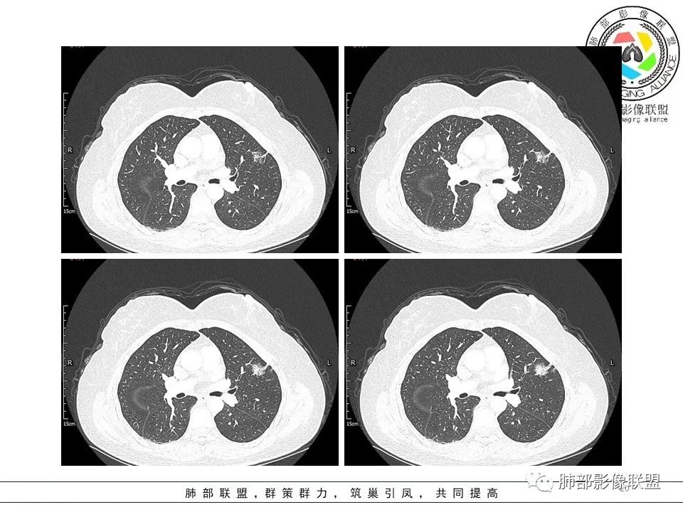 【病例】左肺上叶腺癌1例CT影像讨论 【病例】左肺上叶腺癌1例CT影像讨论