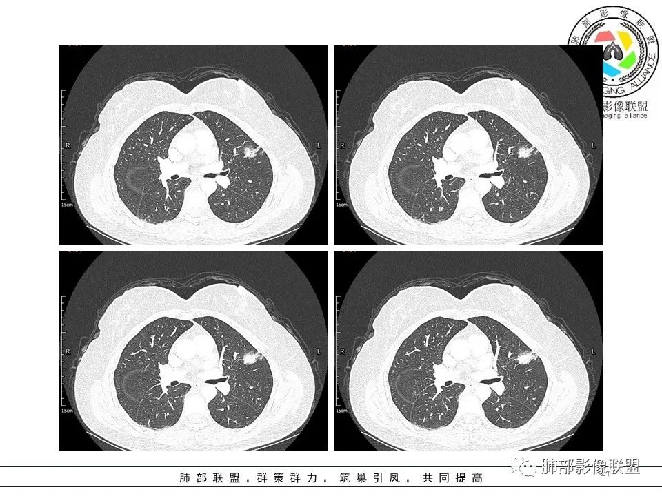 【病例】左肺上叶腺癌1例CT影像讨论 【病例】左肺上叶腺癌1例CT影像讨论