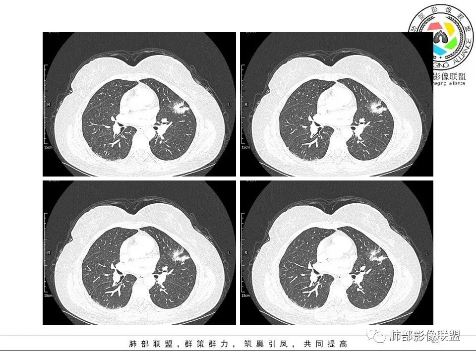 【病例】左肺上叶腺癌1例CT影像讨论 【病例】左肺上叶腺癌1例CT影像讨论